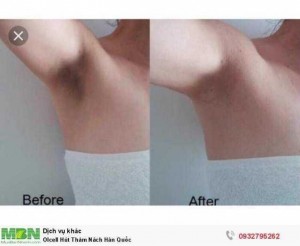 Olcell Hút Thâm Nách Hàn Quốc