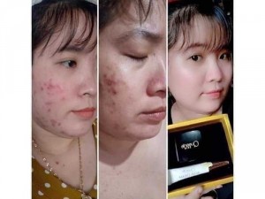 Combo đặc trị mụn Queenie skin