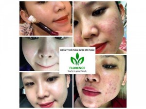 gia công lá nam trị mụn