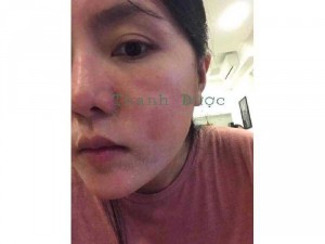 Mỹ phẩm Thanh dược siêu Trị mụn