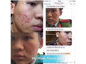 Trị mụn thanh dược khỏi 100%