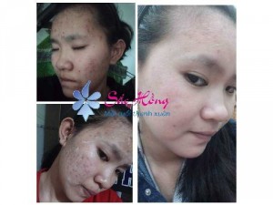 Hàng thật. Mặt thật của mình khi bị mụn.