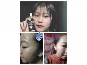 Hàng thật. Mặt thật của mình khi bị mụn.