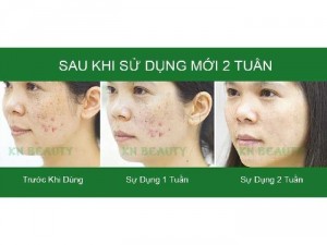 Mỹ phẩm trị mụn thâm KN Beauty