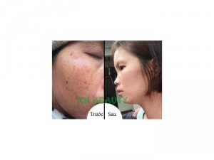 Mỹ phẩm trị mụn thâm KN Beauty