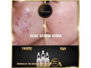 Đặc Trị Mụn Acne Serum Biora