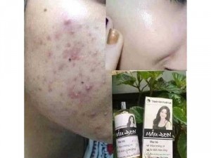 Trị mụn, nám và tàn nhang