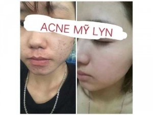 Kem trị mụn Mỹ Lyn Thần Thánh