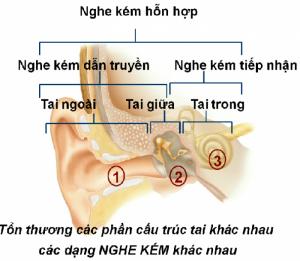 Đeo máy trợ thính là lựa chọn tối ưu cho người nghe kém do tuổi già