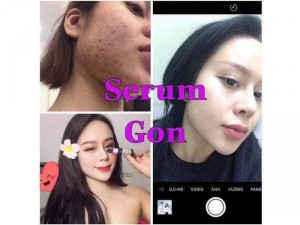 Serum dưỡng da/ trị mụn/ nám GON