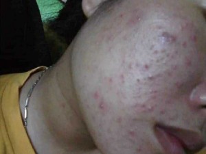 ĐÔNG Y SẮC DƯỢC TRỊ MỤN NÁM