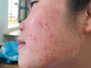 ĐÔNG Y SẮC DƯỢC TRỊ MỤN NÁM