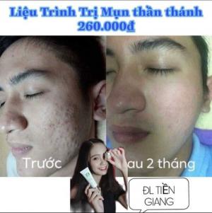 Kem Trị Mụn