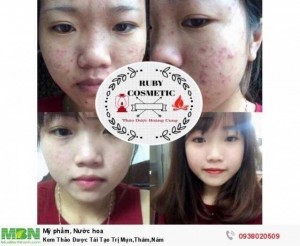Kem Thảo Dược Tái Tạo Trị Mụn,Thâm,Nám