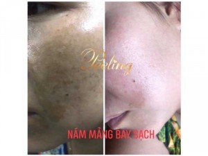 Kem PEELLING tái tạo da, trị nám-tàn nhang