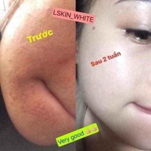 Ủ trắng nuôi da kén tằm