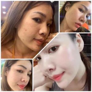 Ủ trắng nuôi da kén tằm