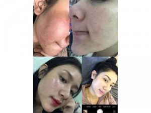 Ủ trắng da kén tằm