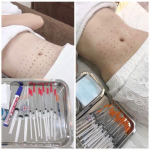 Tiêm giảm mỡ CF line cho spa
