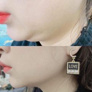 Tiêm giảm mỡ CF line cho spa