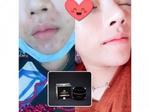 Kem Face trị mụn - thâm - nám - trắng da - chống nắng