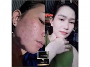 Kem Face trị mụn - thâm - nám - trắng da - chống nắng