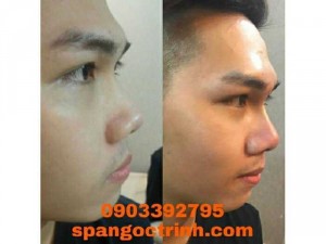 Nâng mũi chỉ giá bao nhiêu