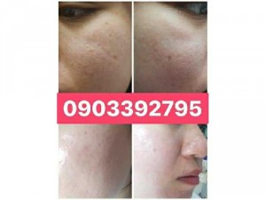 Trị sẹo Rỗ Ngoc Trinh Quận 6