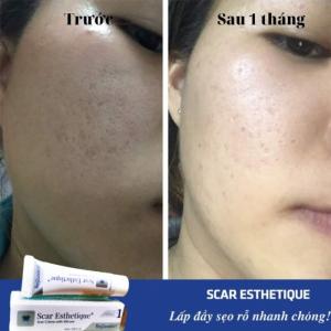 SCAR ESTHETIQUE - KEM TRỊ SẸO MỸ CHÍNH HÃNG