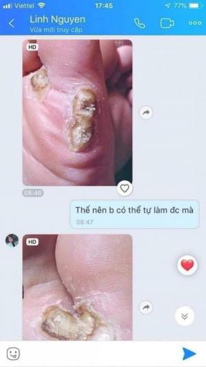 Gel dvelinil Nga tẩy nốt ruồi mụn cơm mụn cóc mụn thịt