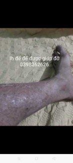 Thuốc bôi ngoài da ngứa vẩy nến khỏi hẳn