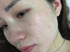 Tinh Chất Sắc Dược Giảm Mụn Mờ Nám