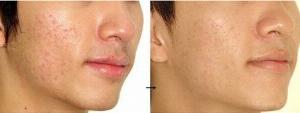 Tắm trắng da mặt Tại Spa