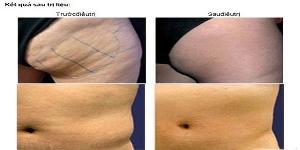 Giảm Mỡ Bụng Công Nghệ RF quận 6