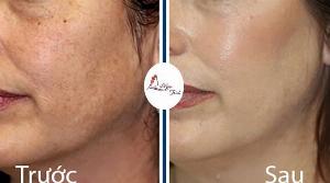 Trị nám tàn nhang bằng laser