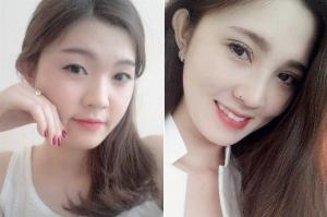 Bấm mí mắt giá bao nhiêu tiền