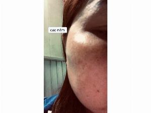 Kem cao nám sắc dược