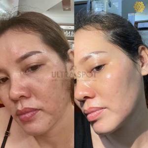 Siêu phẩm trị nám mộc liên hoa