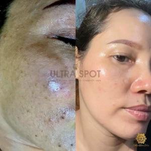 Siêu phẩm trị nám mộc liên hoa