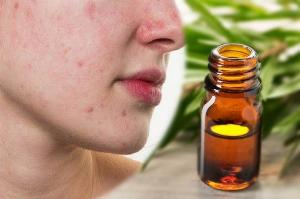Tinh dầu Tràm Trà 10ml xông mặt, loại bỏ mụn ẩn, giảm đau