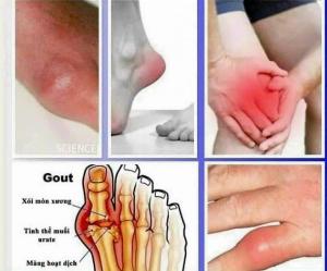 Thuốc trị bệnh gout Hàn Quốc
